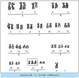 ചിത്രം:Trisomi 21 Sr.png