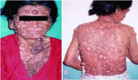 ചിത്രം:Cowden Syndrome-3.png