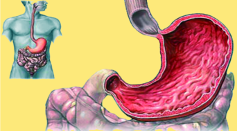 ചിത്രം:Gastritis.png