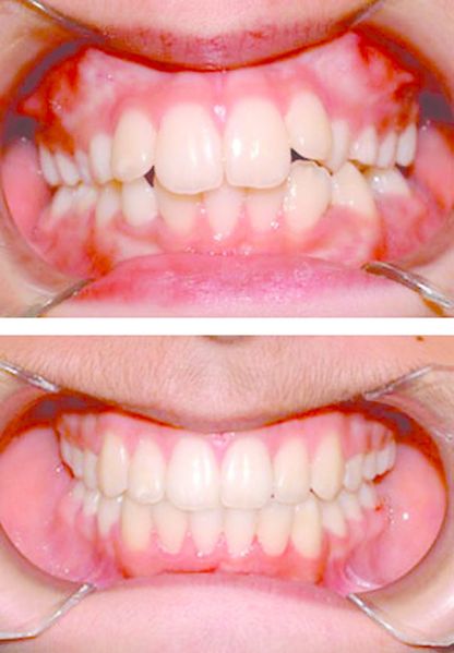 ചിത്രം:Vol5p825 orthodontic before and after.jpg