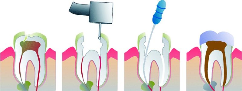 ചിത്രം:Vol5p152 Root Canal Illustration Molar.jpg